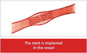 stent-vessel-300x182